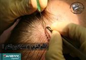 ما حكم الشرع في عمليات زرع الشعر ؟ ما حكم الشرع في عمليات زرع الشعر ؟