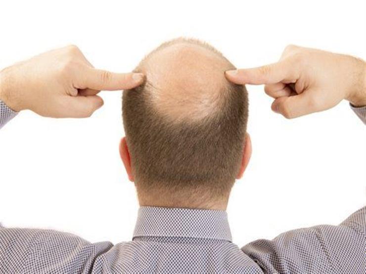 علاج جديد يقضي على الصلع في 28 يومًا علاج جديد يقضي على الصلع في 28 يومًا