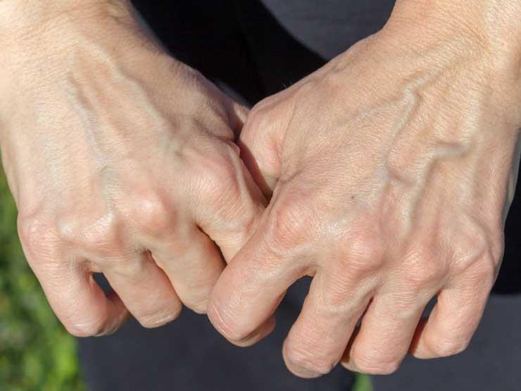 لماذا تظهر عروقنا زرقاء في حين أن الدم أحمر اللون؟ لماذا تظهر عروقنا زرقاء في حين أن الدم أحمر اللون؟