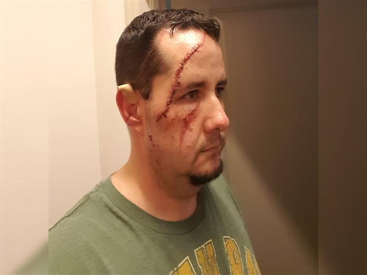 Man survives bear attack with 41 stitches across his face