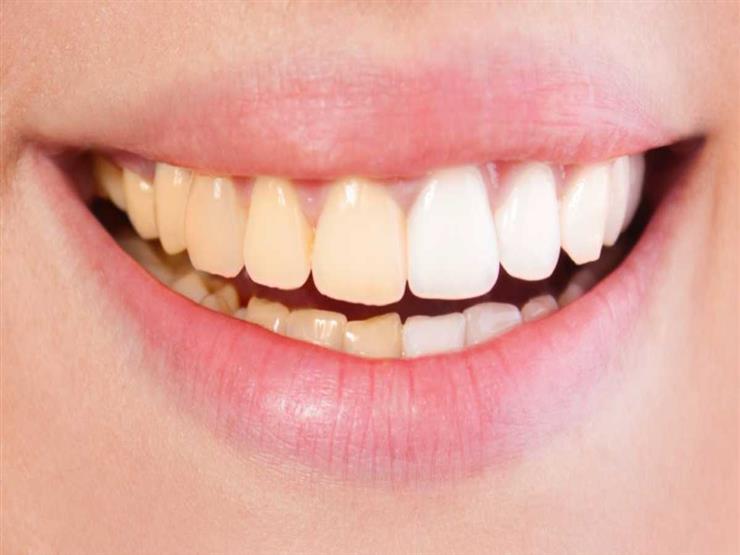 لون الأسنان الصحية.. بيضاء أم صفراء؟ لون الأسنان الصحية.. بيضاء أم صفراء؟