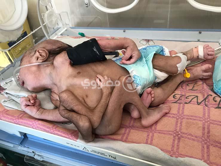 حالة نادرة .. وفاة توأم ملتصق في الإسكندرية...مصراوى حالة نادرة .. وفاة توأم ملتصق في الإسكندرية...مصراوى