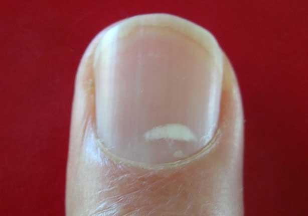 white-spots-fingernail-leukonychia-punctata