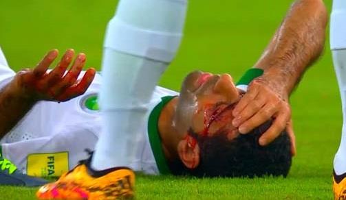 إصابة دموية لنجم المنتخب السعودي (2)