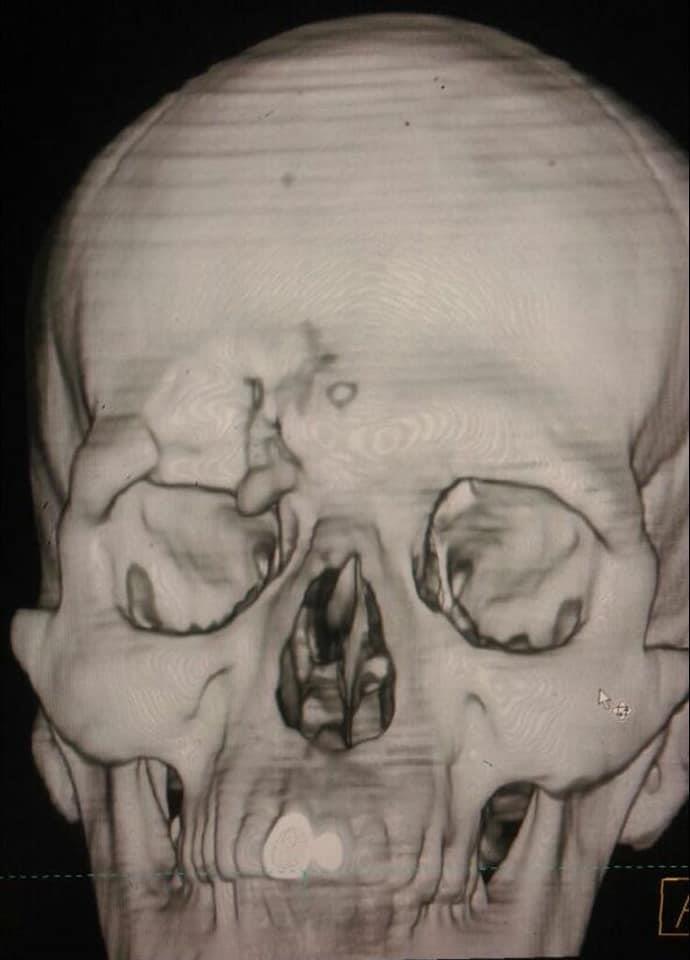 اشعة للمصاب بكسر في الجمجمة قبل الجراحة (1)