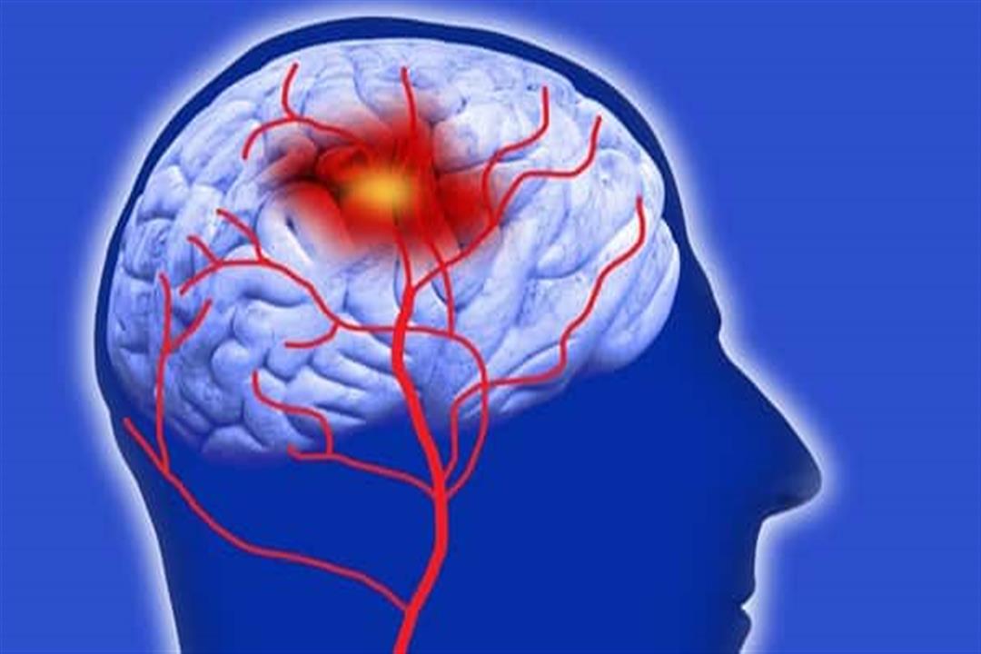 Subarachnoid Hemorrhage Ct