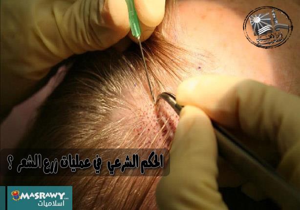 ما حكم الشرع في عمليات زرع الشعر ؟ ما حكم الشرع في عمليات زرع الشعر ؟