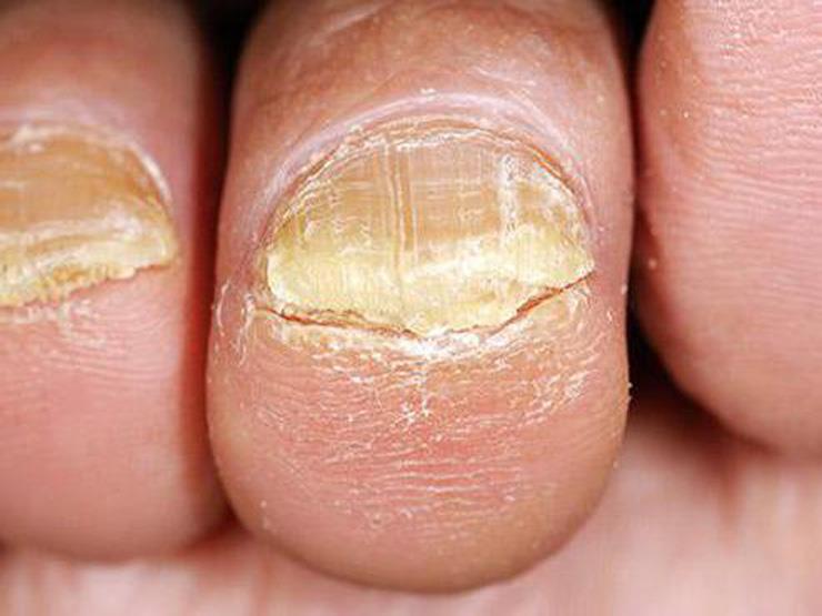 طرق علاج فطريات الأظافر والوقاية منها مصراوى