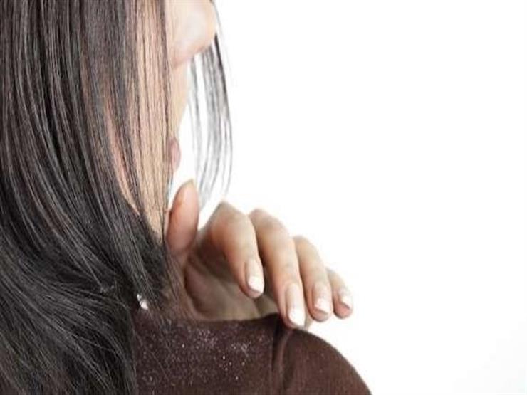 5 طرق منزلية لعلاج قشرة الرأس 5 طرق منزلية لعلاج قشرة الرأس