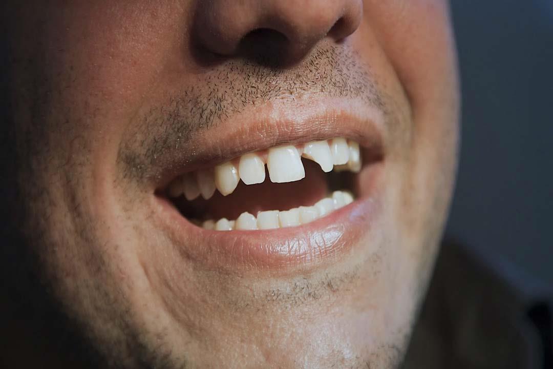 متى تحتاج الأسنان المكسورة لحشو عصب؟ متى تحتاج الأسنان المكسورة لحشو عصب؟