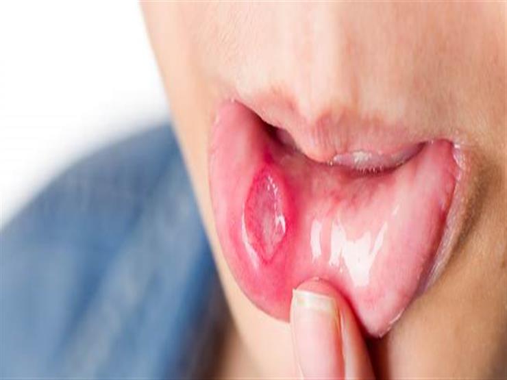 9 أعراض تدل على إصابتك بسرطان الفم.. تعرف عليها 9 أعراض تدل على إصابتك بسرطان الفم.. تعرف عليها