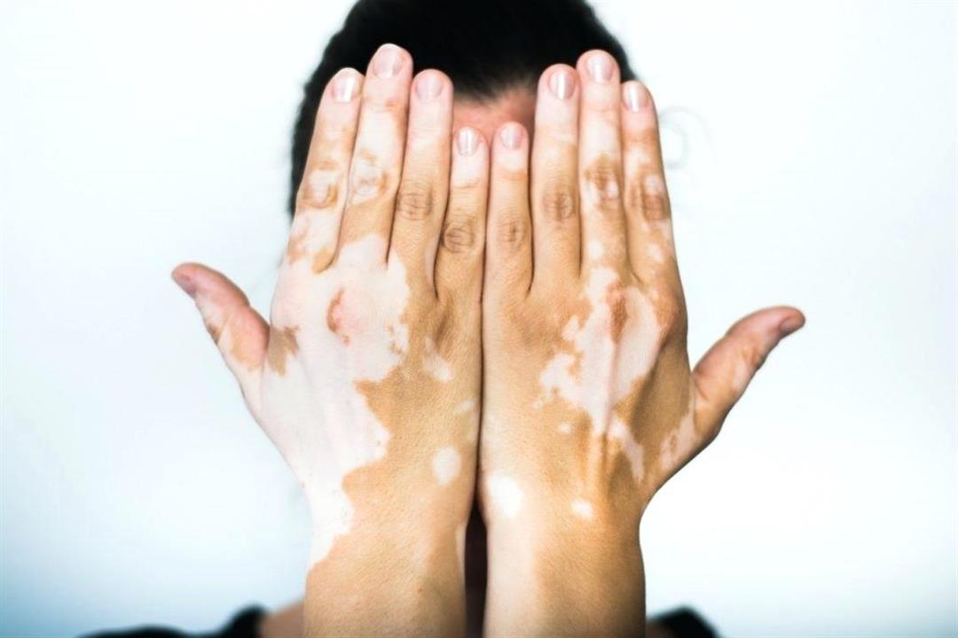 لمرضى البهاق.. قائمة بأبرز الأطعمة التي تساهم في علاجه والوقاية منه لمرضى البهاق.. قائمة بأبرز الأطعمة التي تساهم في علاجه والوقاية منه