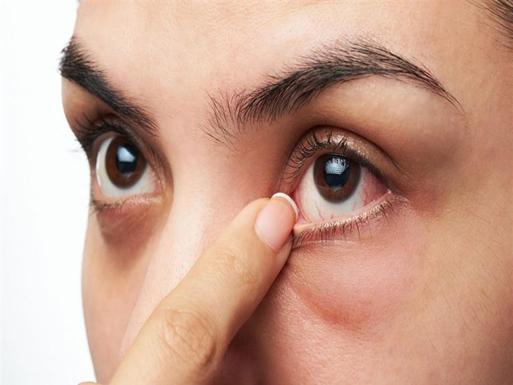 تعرف على أسباب أحمرار العين وهذه طرق علاجها مصراوى