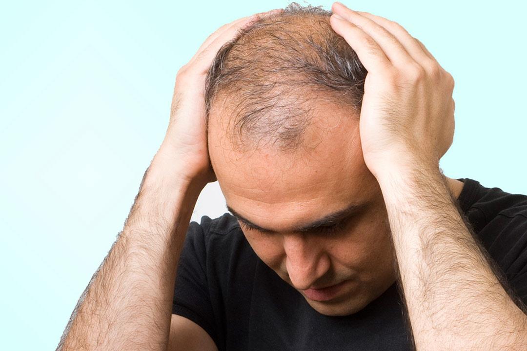توفي في عملية زراعة الشعر.. ما السبب؟ توفي في عملية زراعة الشعر.. ما السبب؟