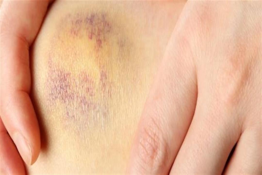 3 أسباب لظهور الكدمات المفاجئة.. إليك طرق علاجها 3 أسباب لظهور الكدمات المفاجئة.. إليك طرق علاجها
