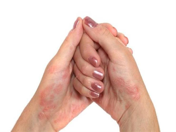 5 نصائح لمواجهة الصدفية خلال حرارة الصيف 5 نصائح لمواجهة الصدفية خلال حرارة الصيف