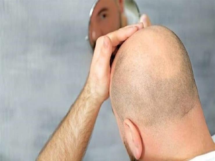 للرجال والنساء.. إنجاز طبي مهم في علاج الصلع للرجال والنساء.. إنجاز طبي مهم في علاج الصلع