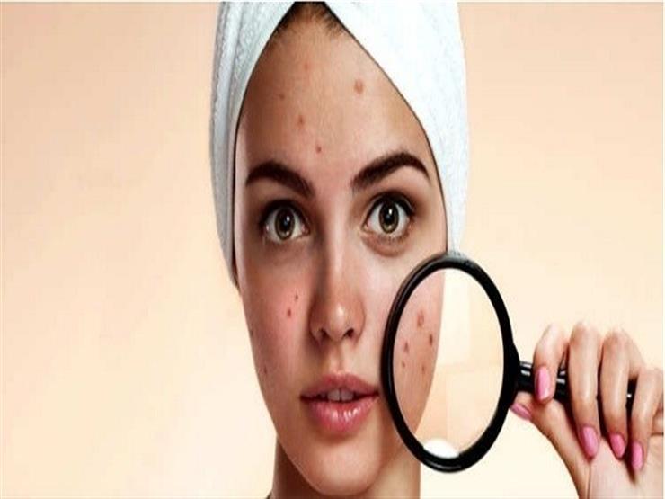 5 نصائح للتعامل مع حب الشباب خلال الحمل (صور) 5 نصائح للتعامل مع حب الشباب خلال الحمل (صور)