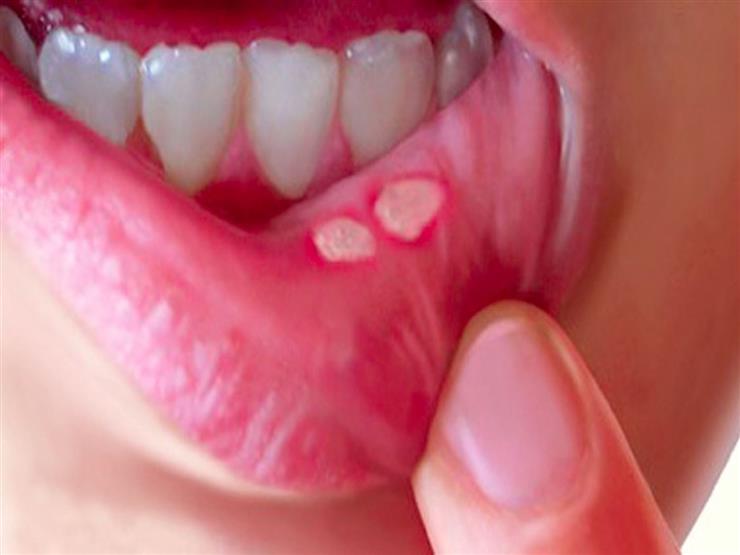 القرحة الفموية .. متى تستلزم استشارة الطبيب؟ القرحة الفموية .. متى تستلزم استشارة الطبيب؟
