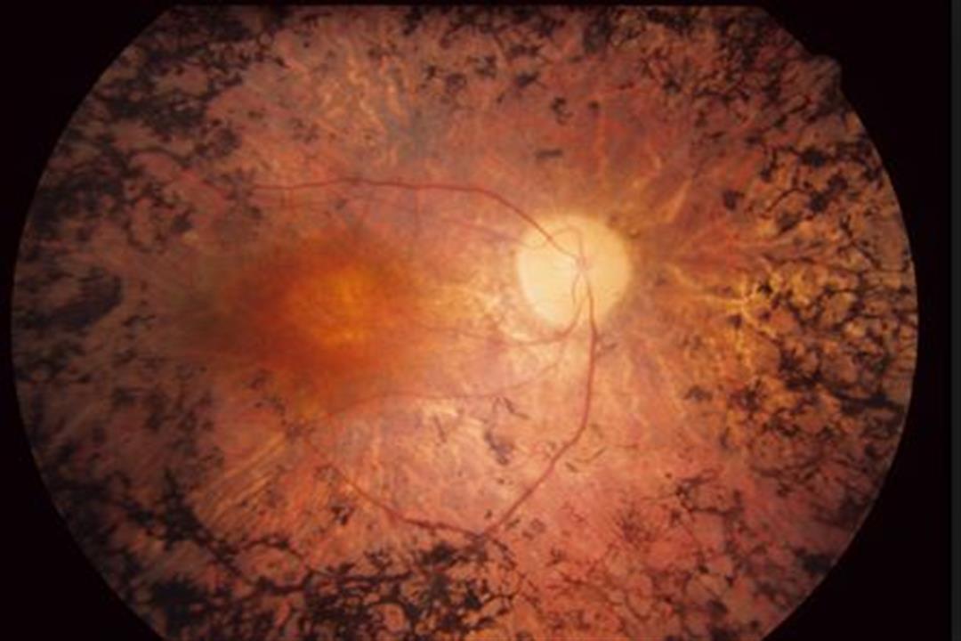 Воспаление сетчатки. Тапеторетинальная дистрофия сетчатки. Пигментный ретинит сетчатки. Пигментная дегенерация сетчатки. Пигментный ретинит и абиотрофия сетчатки.