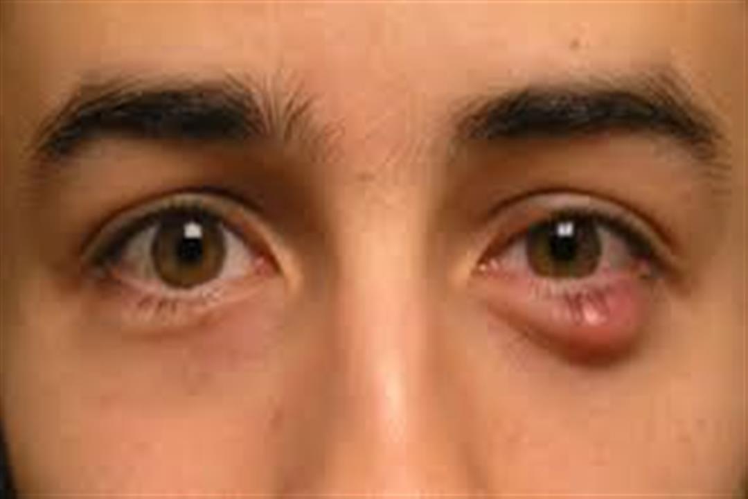 طرق بسيطة لعلاج الكيس الدهني في العين.. متى يحتاج لجراحة؟