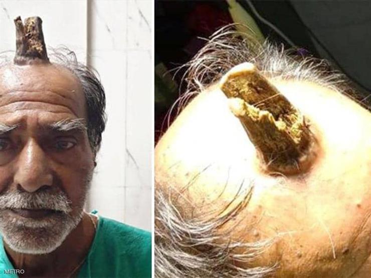 بعدما زاد عن حده.. رجل اضطر إلى استئصال "قرن الشيطان" بعدما زاد عن حده.. رجل اضطر إلى استئصال "قرن الشيطان"