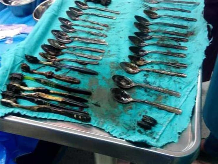 "20 ملعقة و4 شوك و7 فرش".. رئيس الفريق الطبي يكشف تفاصيل عملية "شاب المنصورة" (حوار) "20 ملعقة و4 شوك و7 فرش".. رئيس الفريق الطبي يكشف تفاصيل عملية "شاب المنصورة" (حوار)