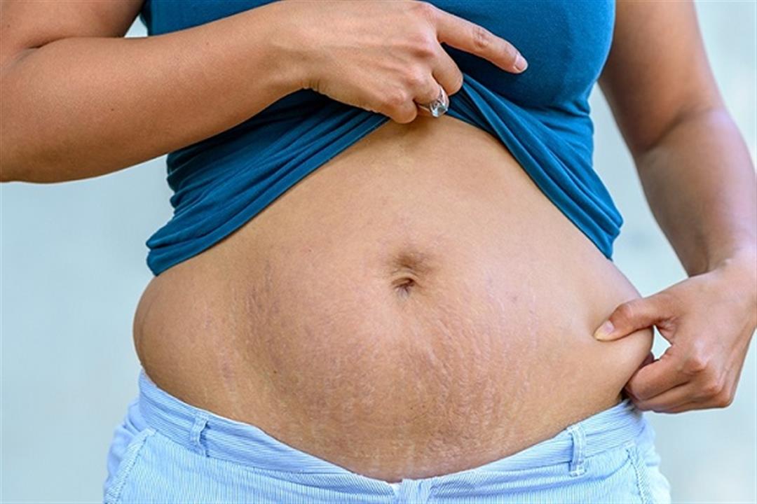 كرش الولادة القيصرية.. 5 نصائح تساعدِك على التخلص منه كرش الولادة القيصرية.. 5 نصائح تساعدِك على التخلص منه