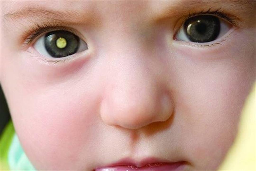 مرض كوتس يهدد طفلِك بالعمى.. 5 أعراض تكشف الإصابة به مرض كوتس يهدد طفلِك بالعمى.. 5 أعراض تكشف الإصابة به