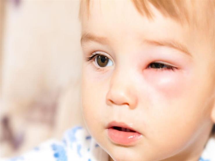 ما أسباب التهاب ملتحمة العين لدى الطفل؟ | مصراوى