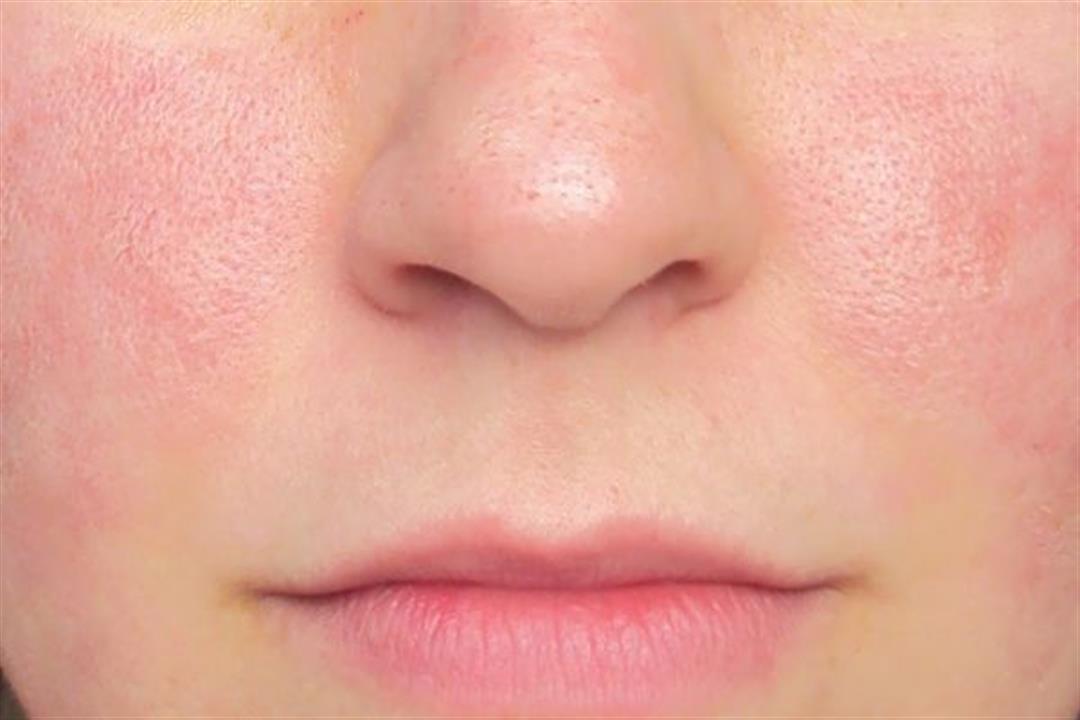 5 طرق طبيعية تخلصك من مسام البشرة الواسعة (صور) 5 طرق طبيعية تخلصك من مسام البشرة الواسعة (صور)
