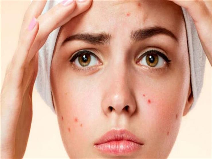 Suffering from acne? .. A dermatologist offers the best way to get rid of it