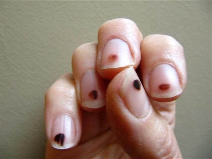 Oncologist reveals how to predict cancer with nails