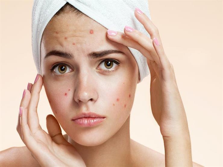 Attention .. acne is unknowing to tell you of health problems you suffer from